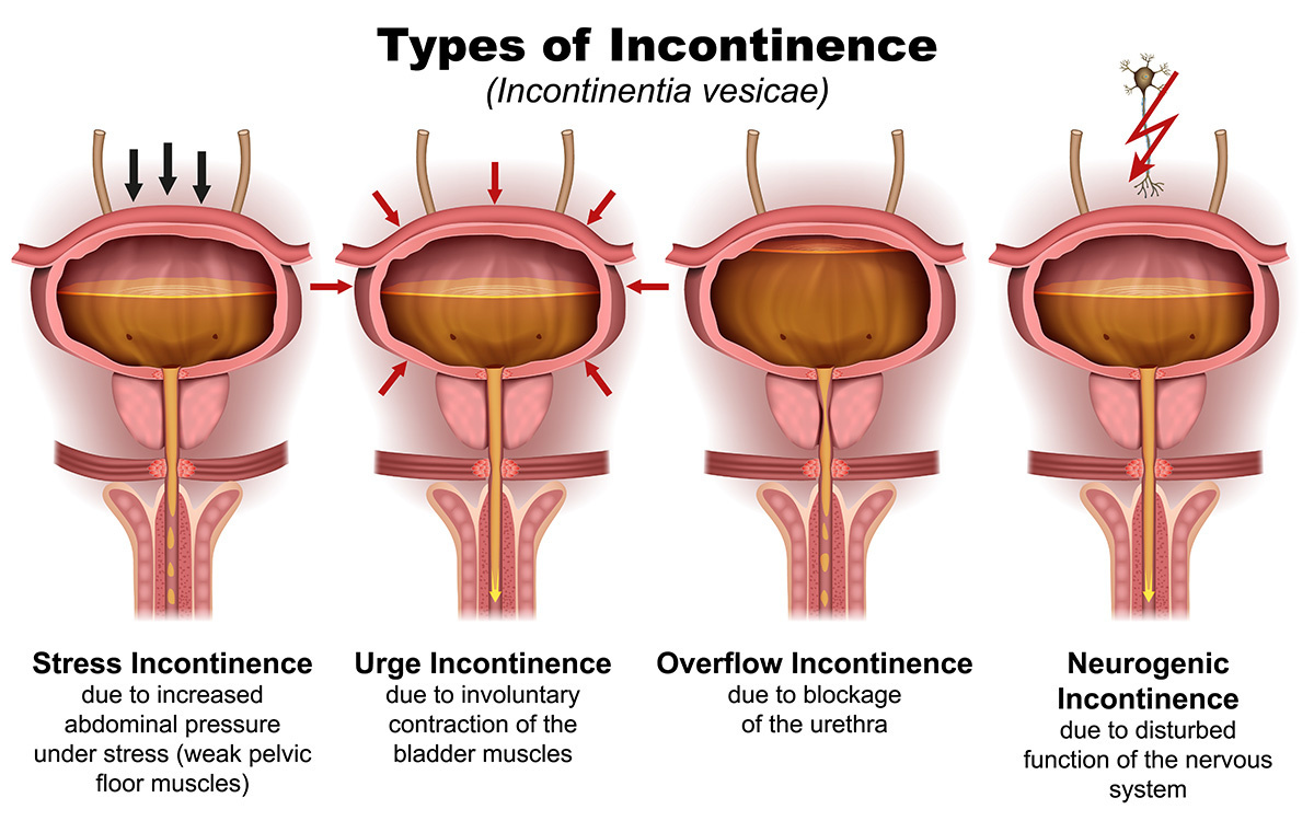 Female Stress Urinary Incontinence Treatment Devices Market: Driving Forces and Disruptive Trends [2029]  