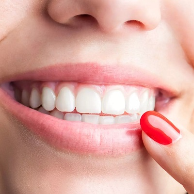 Teeth Whitening and Braces: Can You Do Both?