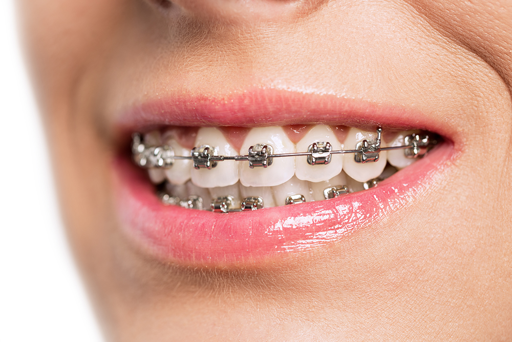 The Role of X-Rays in Your Braces Journey