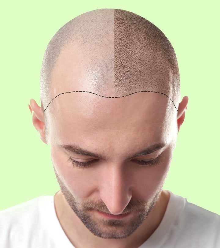 Why Riyadh is Becoming a Hub for Hair Transplants