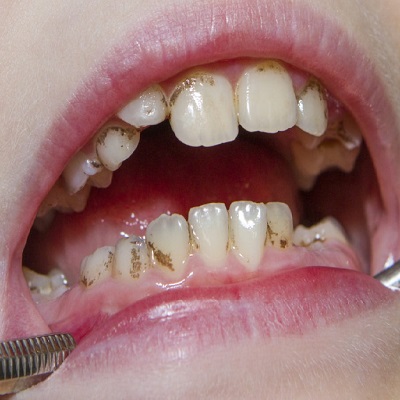 The Future of Teeth Whitening and Stain Removal in Dubai