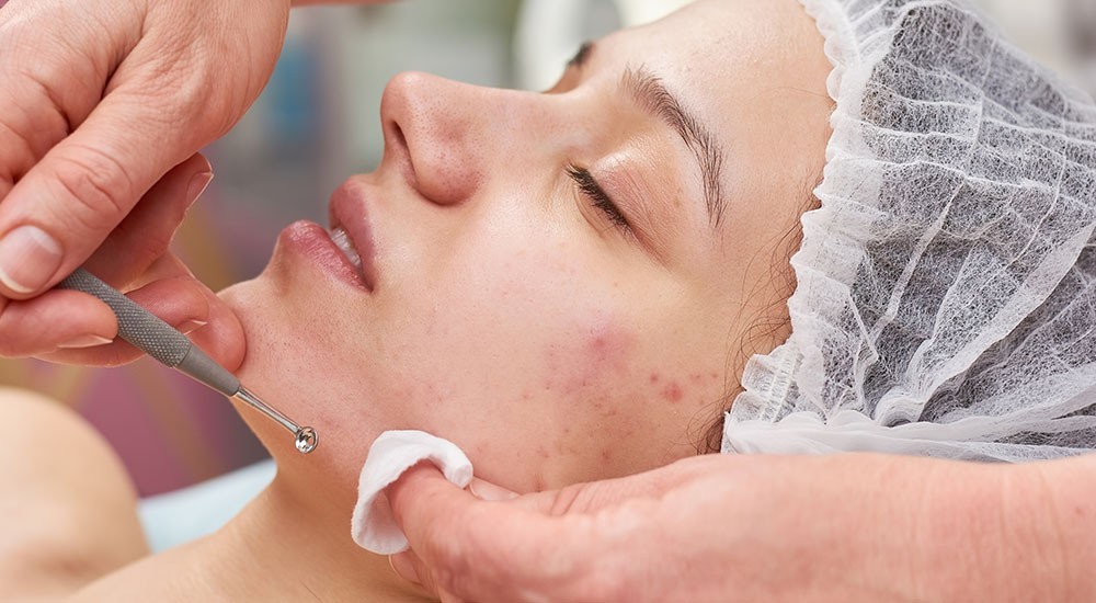 How to Choose the Right Acne Treatment for Your Skin in Dubai