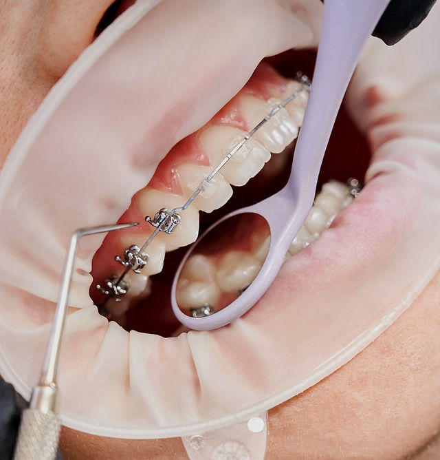 What Determines the Price of Braces in Dubai?