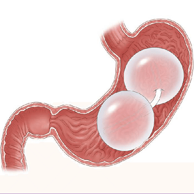The Science Behind the Gastric Balloon Why Dubai Is Leading the Way in Non-Surgical Weight Loss