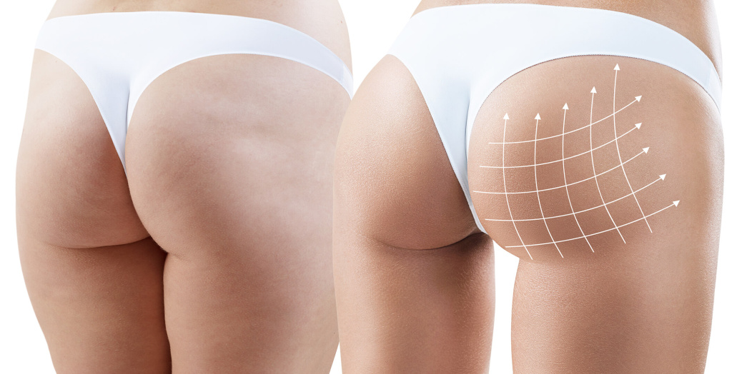 How long does a Brazilian butt lift last insights from Riyadh experts