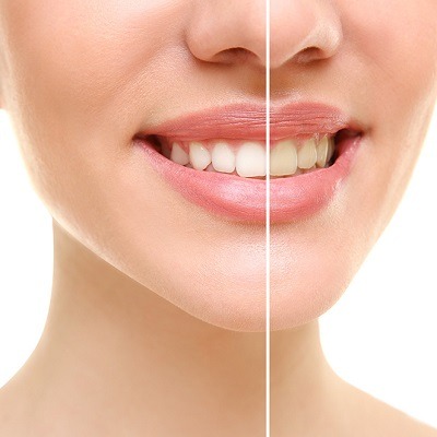 Effective Solutions for Brightening Your Smile: A Guide to Dental Stain Removal