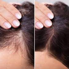 PRP for Hair Loss in Dubai A Game-Changer for Thicker, Healthier Hair