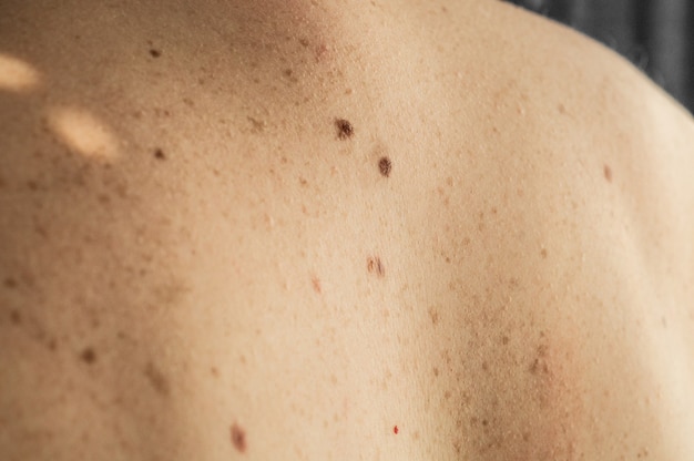What to Expect During Your Warts Removal Appointment?