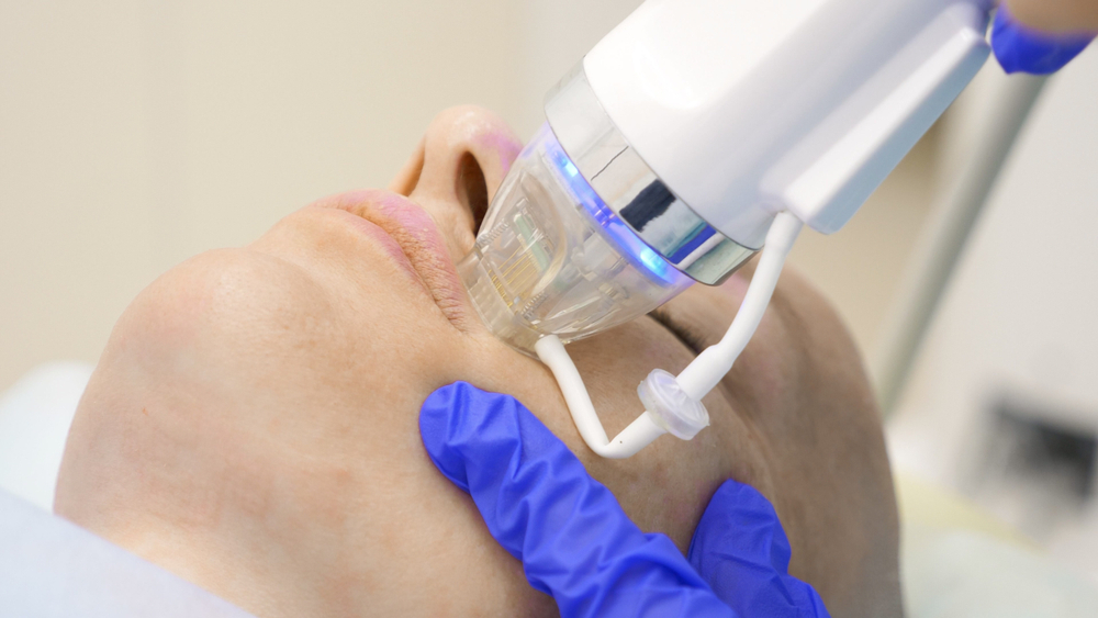 Fractional RF Microneedling: How It Works for Dubai’s Skin Needs