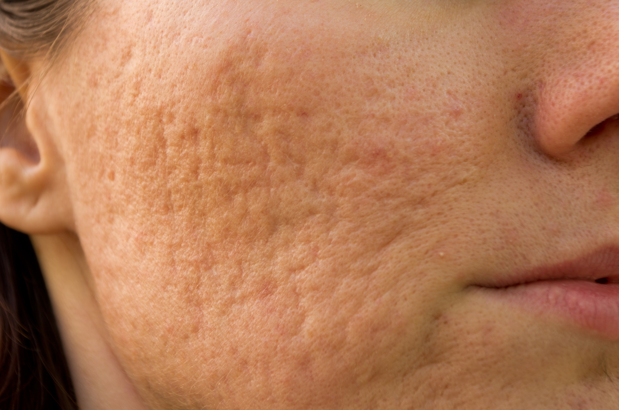 What Happens During Laser Scar Removal? Here’s the Scoop