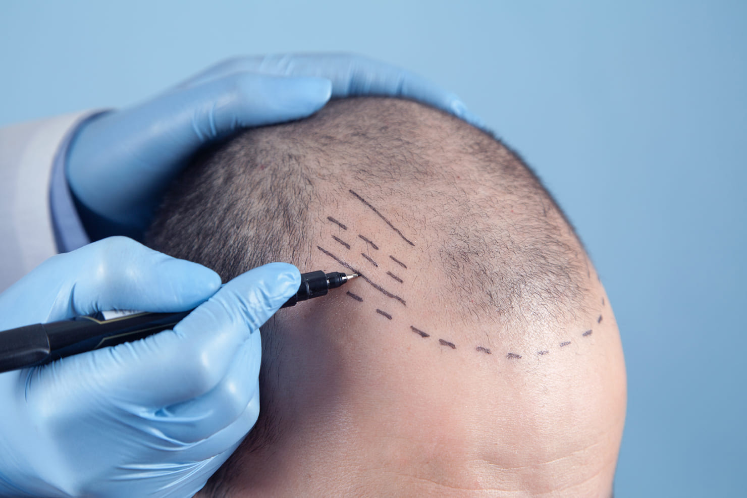 Cost of Hair Grafts in Riyadh: How It’s Calculated