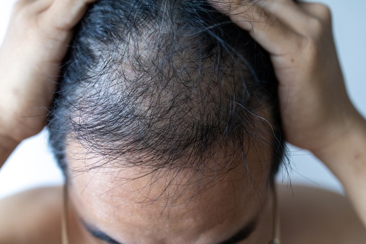 Finasteride: The Pros and Cons of Using It for Hair Loss