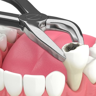 Minimally Invasive Options for Wisdom Tooth Removal in Dubai