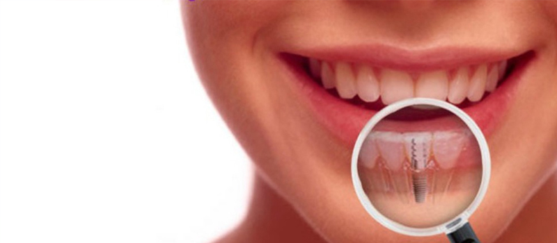Why Dental Implants Are the Gold Standard in Tooth Replacement