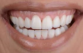 كيف يساعد نحت اللثة في الرياض في تحسين شكل وجهك؟