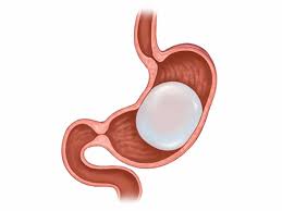 Comparing Gastric Balloon Placement to Other Weight Loss Treatments in Dubai