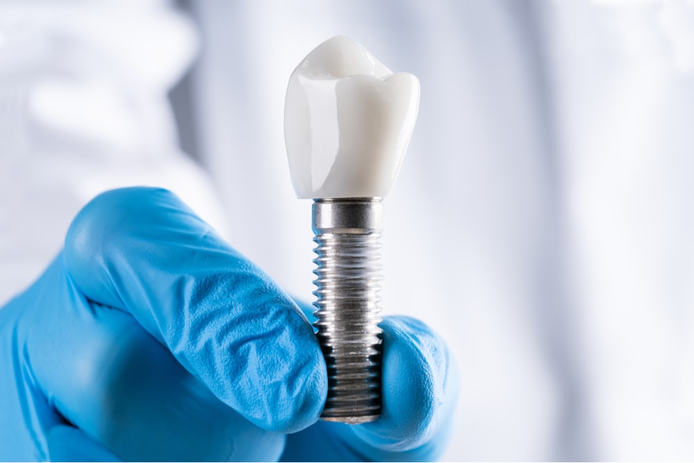 The Role of 3D Imaging in Precise Dental Implant Placement