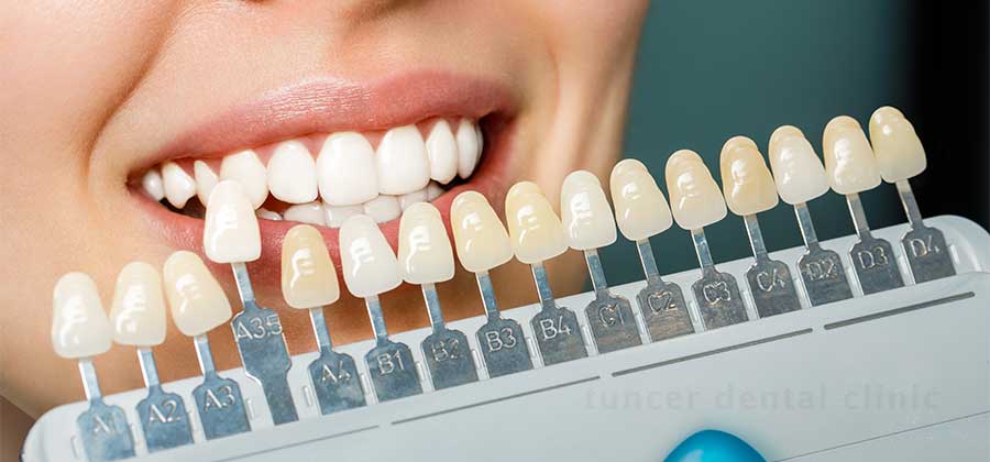 How to Choose the Best Dental Veneers for Your Lifestyle