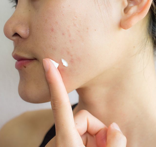 What Are the Best Acne Treatments for Long-Lasting Results?