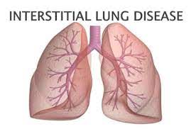 Interstitial Lung Disease (ILD) Market: Growth Drivers, Emerging Trends, and Forecast 2023 to 2032