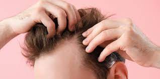 Exploring the Connection Between Diet and Hair Loss