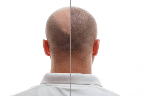 تجارب ناجحة لزراعة الشعر في الرياض: قصص ملهمة