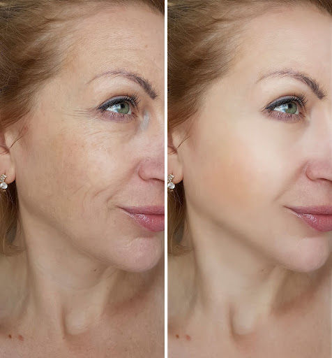 The Secret to Ageless Beauty: Endolift in Dubai