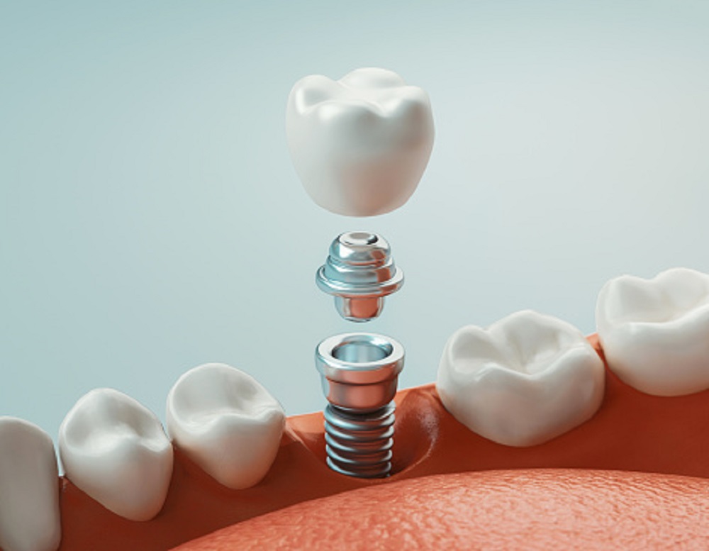 Is a Single Tooth Implant The Best Option for Replacing a Missing Tooth?