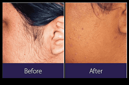 Laser Hair Removal and Its Compliance with Islamic Teachings