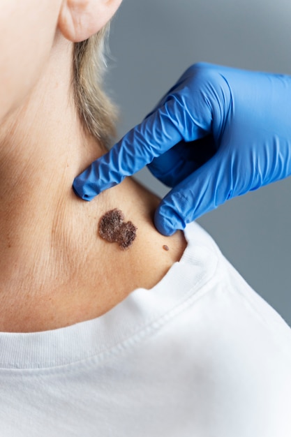 How to remove warts fast?