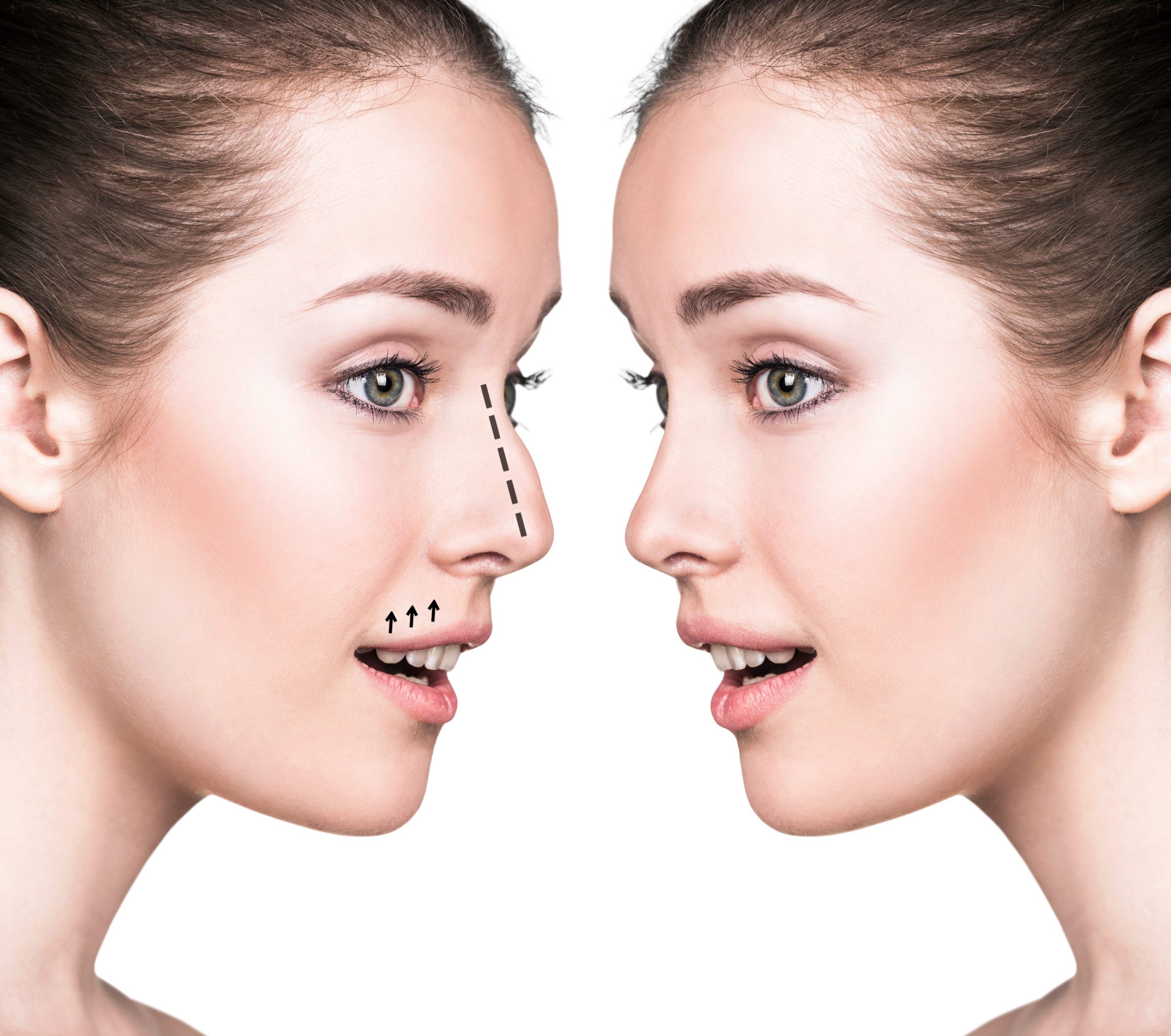 Experience Top-Notch Rhinoplasty Services in Riyadh Today!