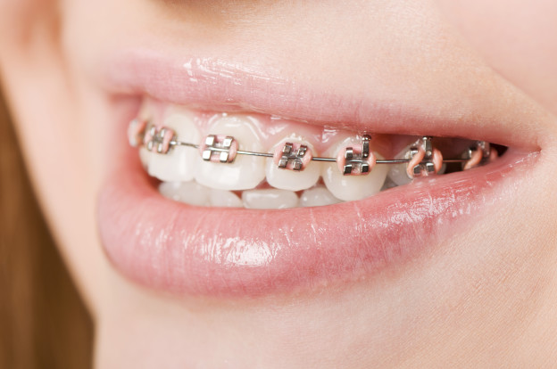 10 Things No One Tells You About Life with Braces