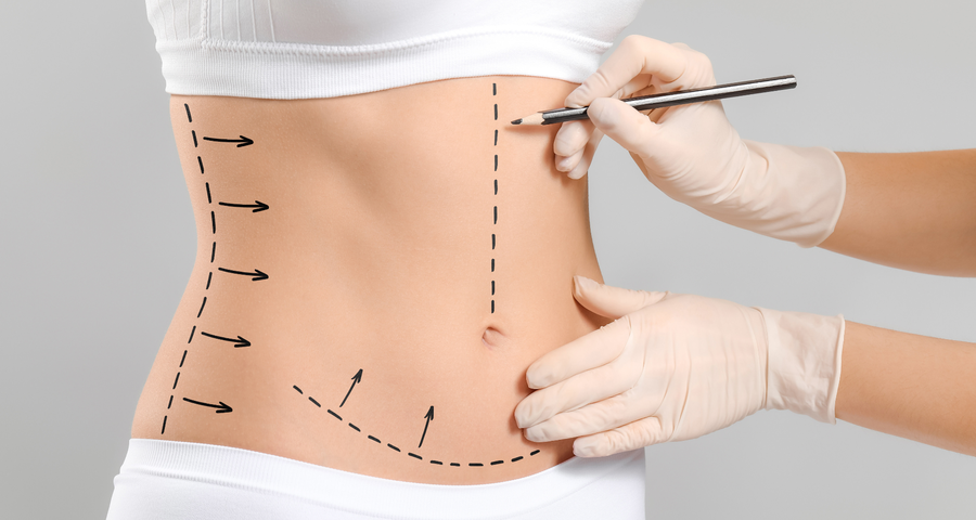 Combination treatments tummy tuck with liposuction in Riyadh
