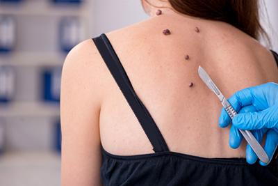 Safe and Effective Mole Removal Surgery in Riyadh