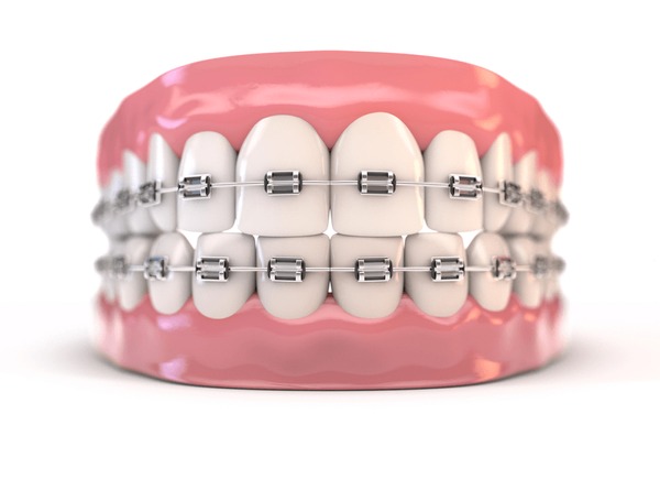 Breaking Down the Myths: Common Misconceptions About Braces