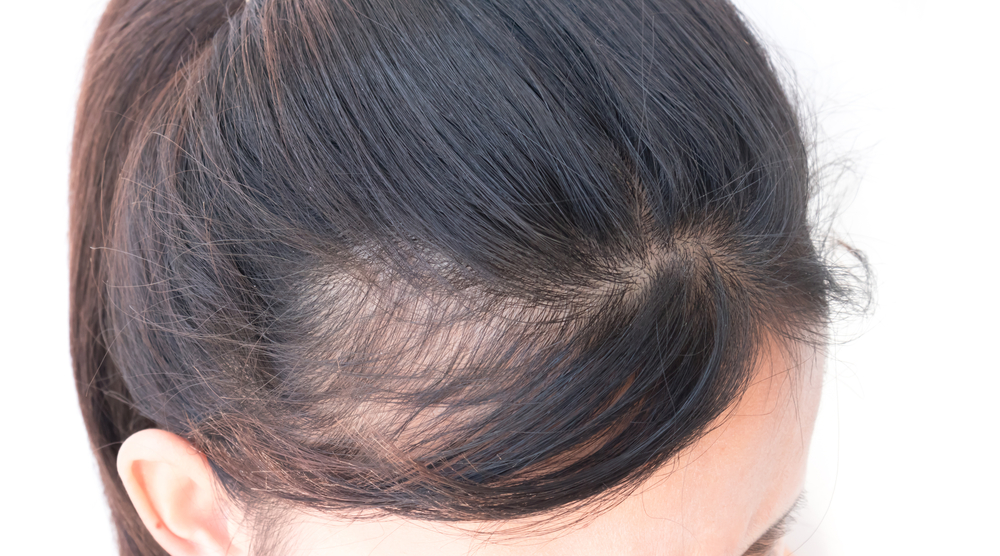 زراعة الشعر في دبي مصممة خصيصًا لك