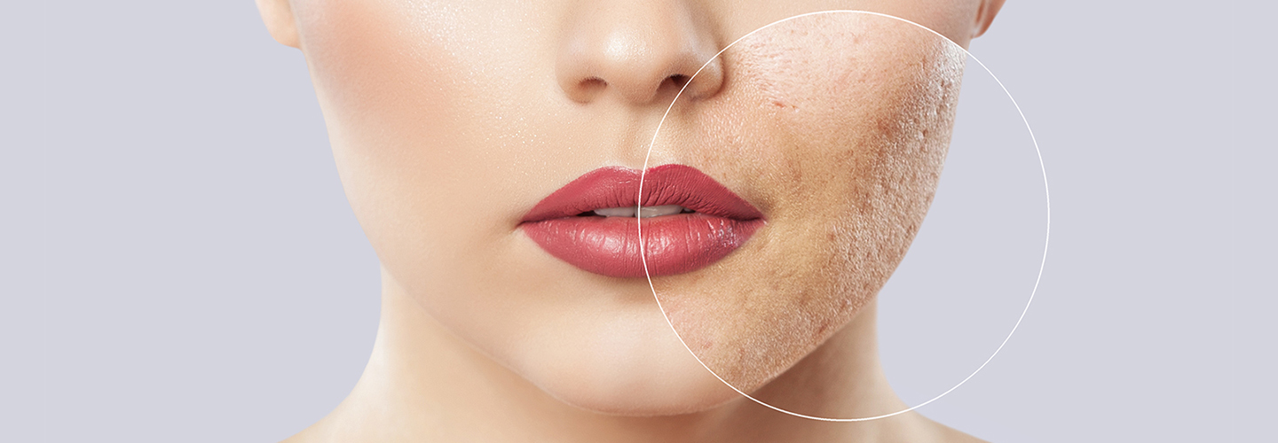 Your Guide to Advanced Acne Scar Treatments in Riyadh