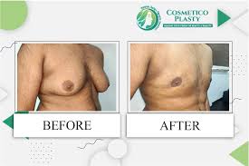 Gynecomastia Surgery in Lahore: Cost, Procedure, and Benefits at Cosmeticoplasty