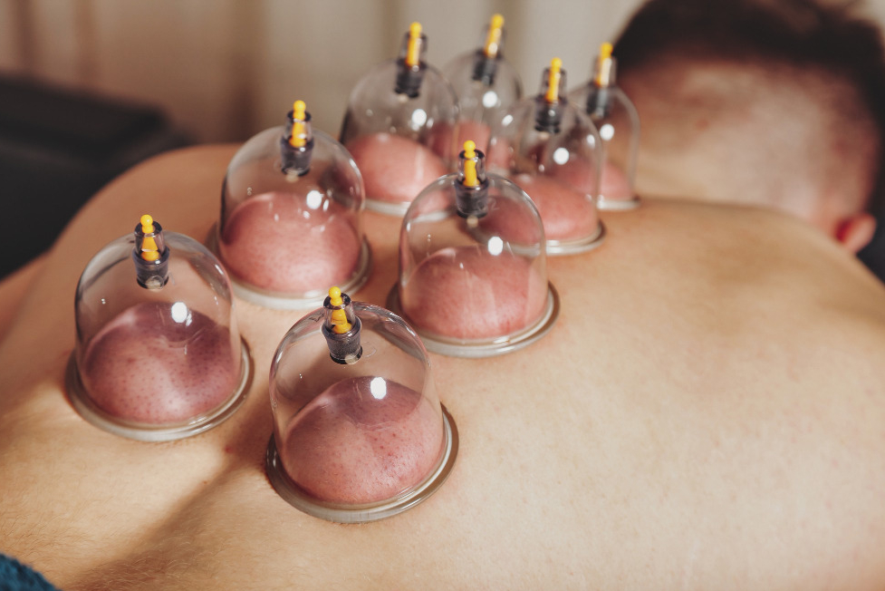 How Hijama Cupping Therapy Relieves Tension