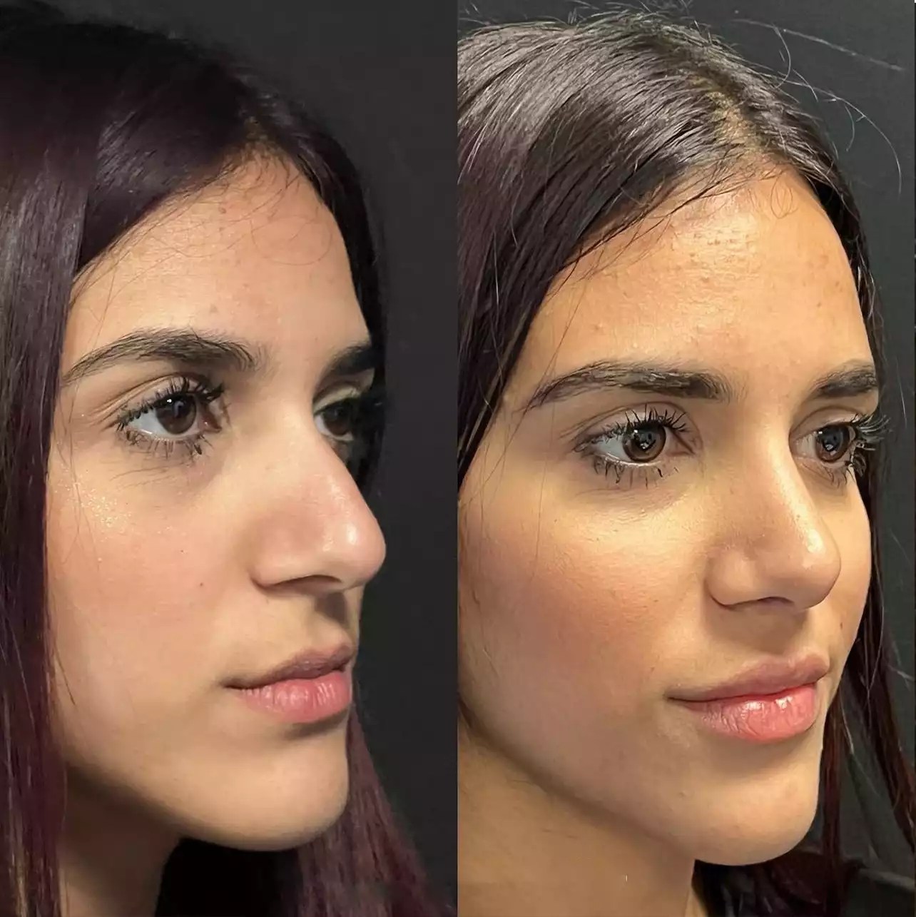 Can Rhinoplasty Improve Nose Shape in Dubai?