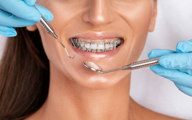 "Orthodontic Excellence in Riyadh: Your Path to a Confident Smile"