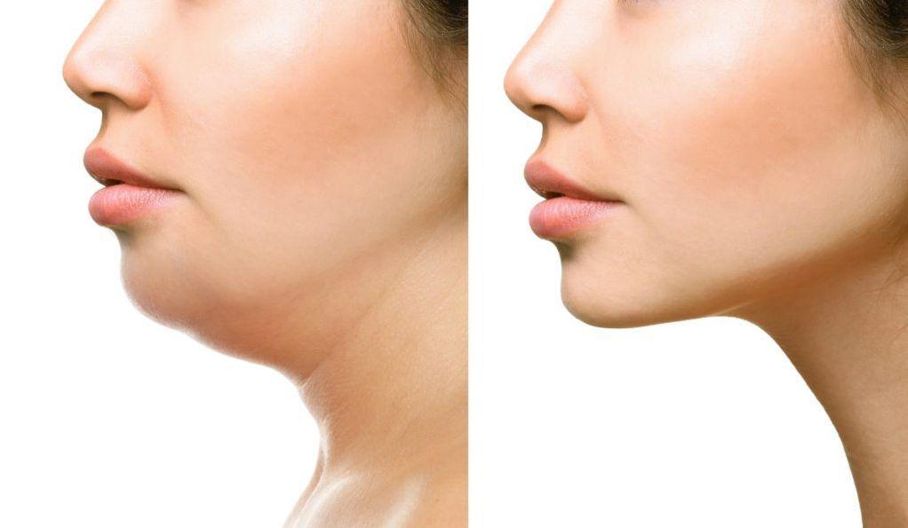 VASER liposuction for double chin in Riyadh what to expect