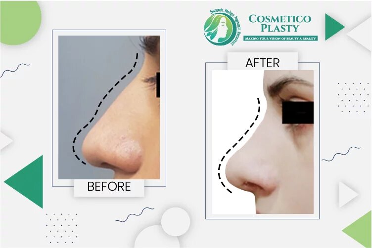 Cosmeticoplasty: Find the Best Rhinoplasty Surgeon in Lahore