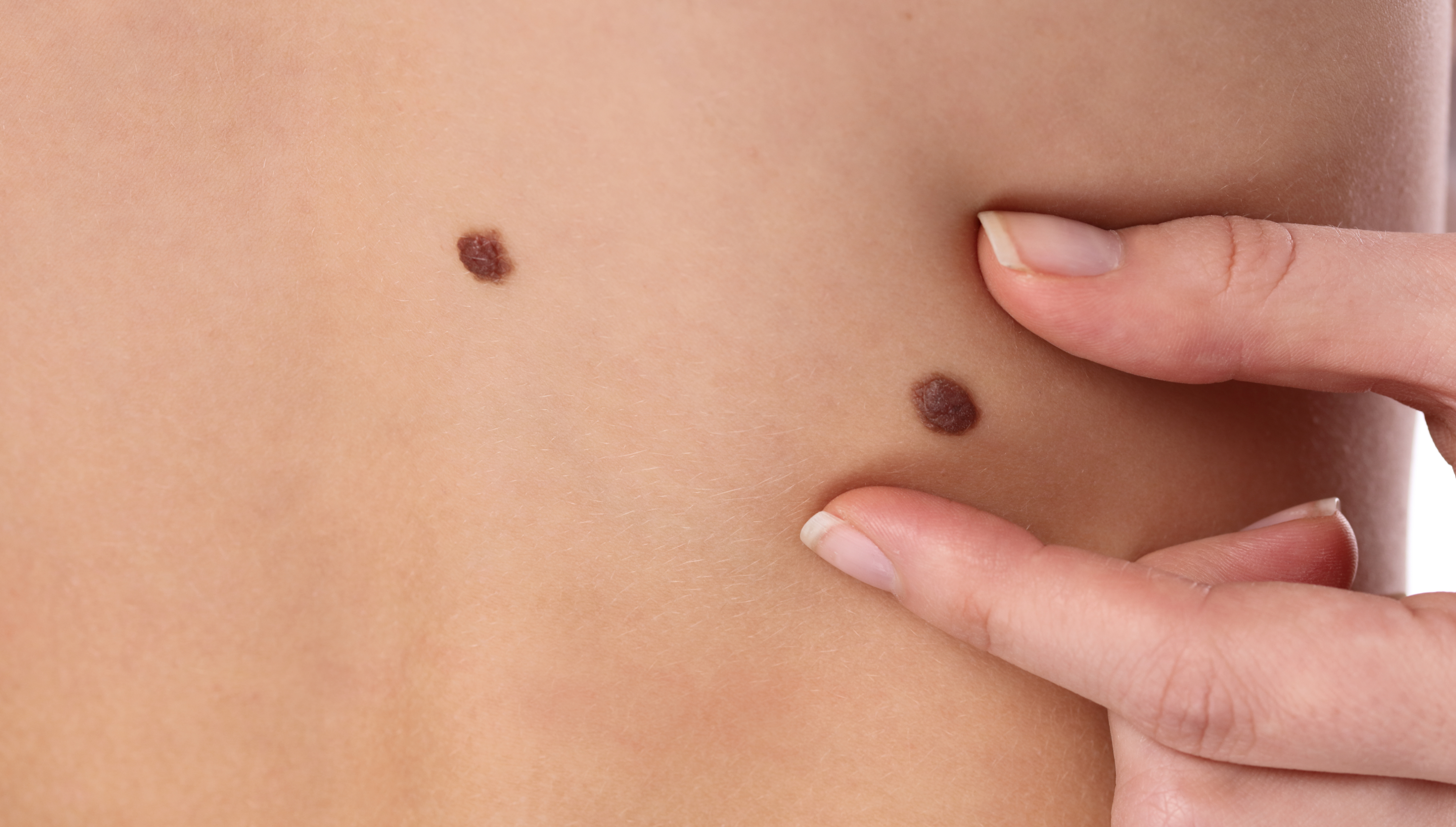 Can your body get rid of warts on its own?