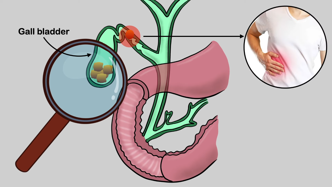 Diagnosing and Treating Gallbladder Stones: A Guide for Karachi's Patient
