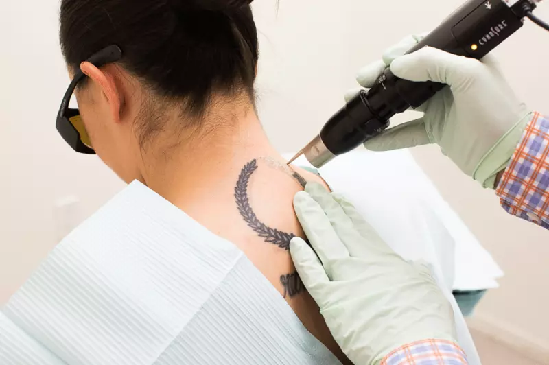 How PicoSure Tattoo Removal Technology Guarantees Faster and Finer Results