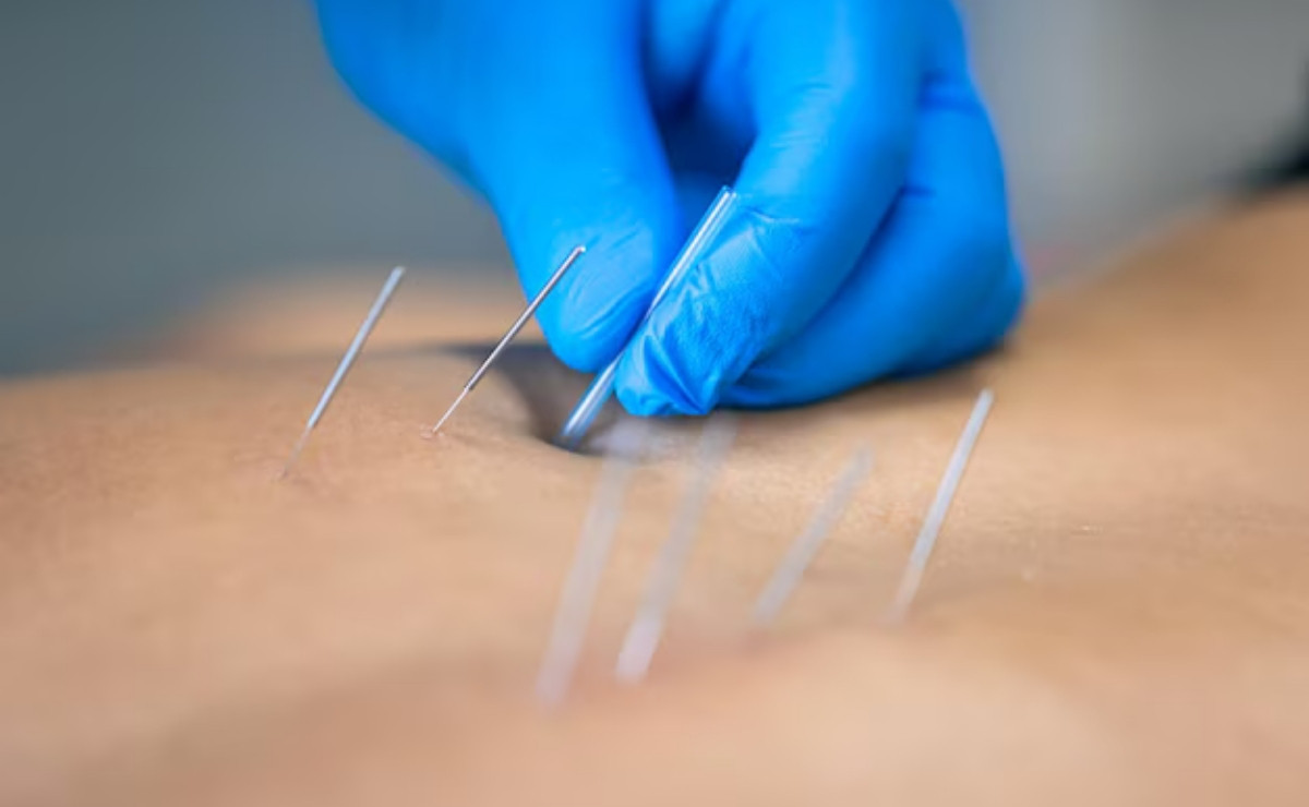 Why Choose Dry Needling for Pain Management in Dallas?