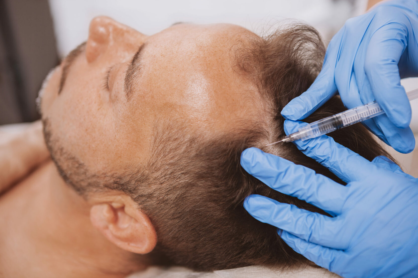 Long-Term Benefits of Hair Transplants in Riyadh