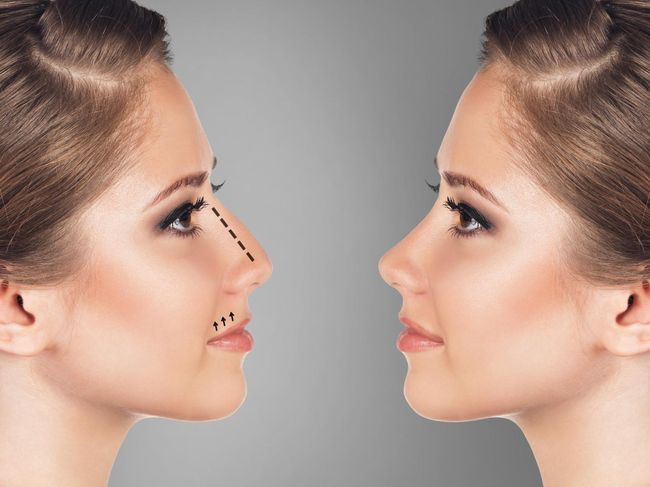 Pre-Rhinoplasty Consultation Tips in Dubai