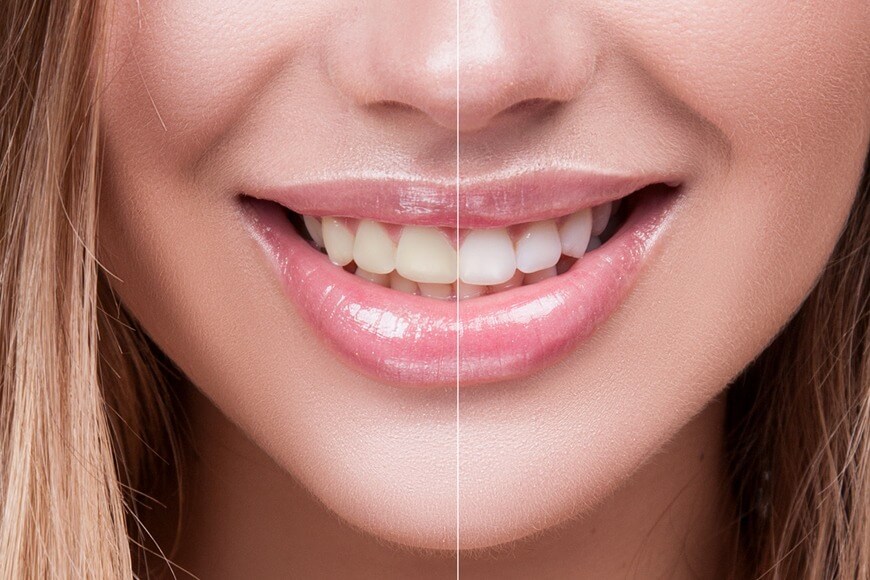 Explore Effective Teeth Whitening Solutions in Dubai Today